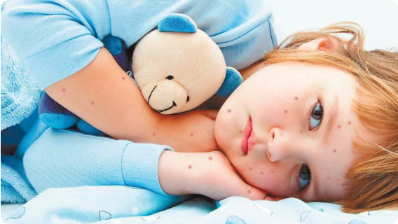 Съвети за облекчаване симптомите на варицела - preview