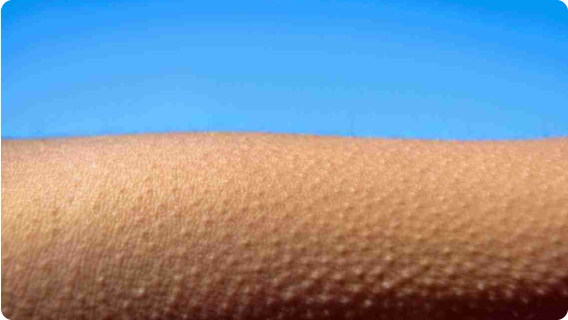 Гъша кожа – що е то и как да се отървем от нея?