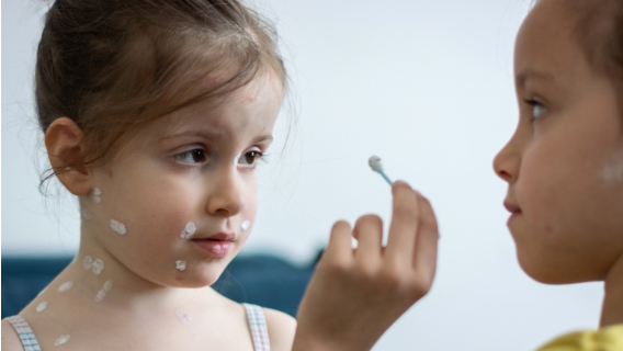 Варицелата - симптоми и разпознаване