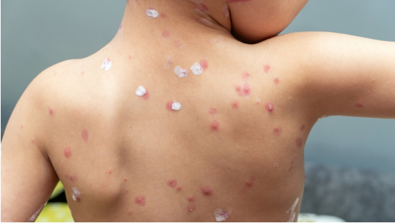 Какво представлява скарлатината и как да я установим и лекуваме?