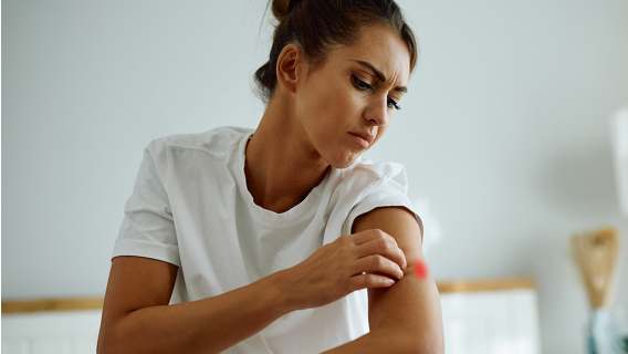 Ухапване от комари - симптоми и превенция