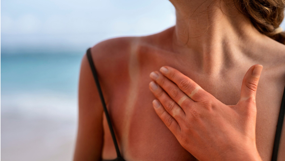 Първа помощ при слънчеви изгаряния и топлинен удар