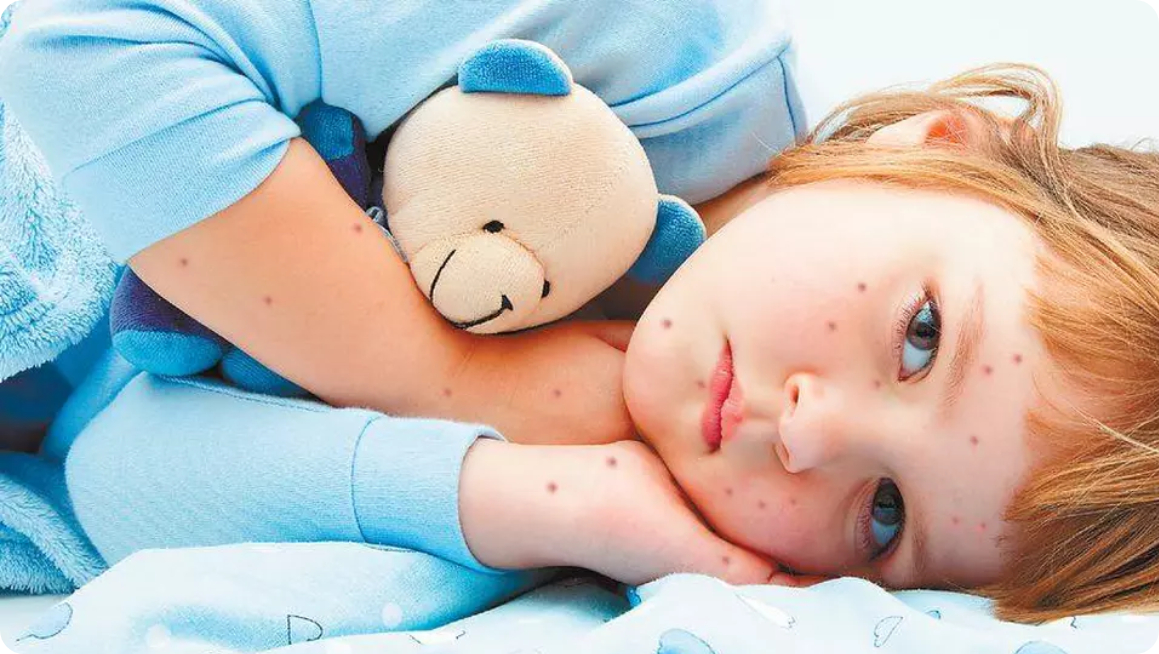 Съвети за облекчаване симптомите на варицела