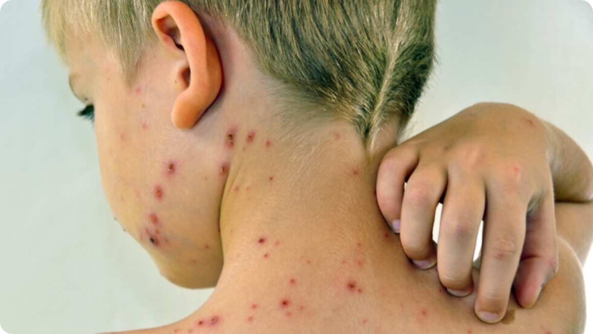 Съвети за облекчаване симптомите на варицела