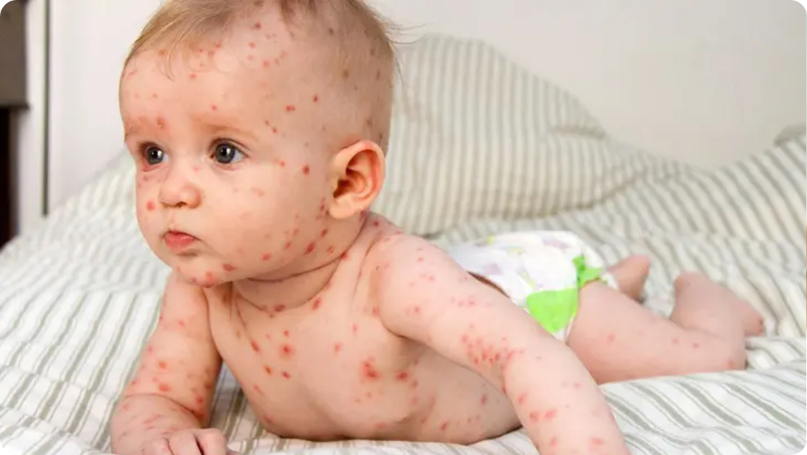 Съвети за облекчаване симптомите на варицела