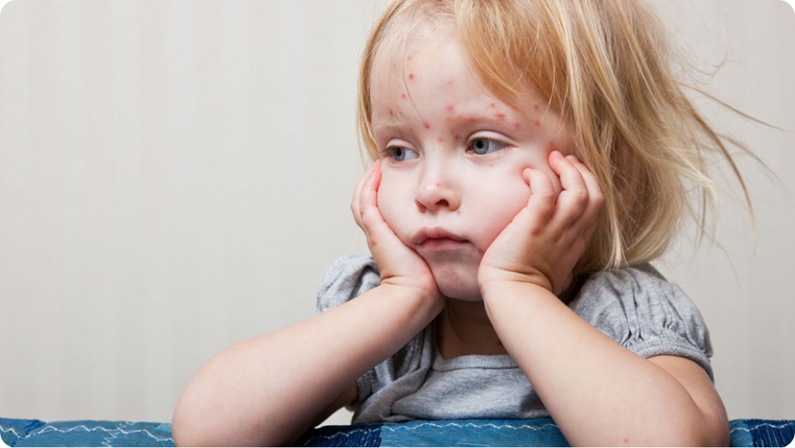 Съвети за облекчаване симптомите на варицела